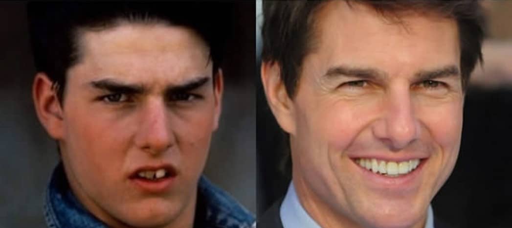 tom cruise carillas famosos dentistas barcelona