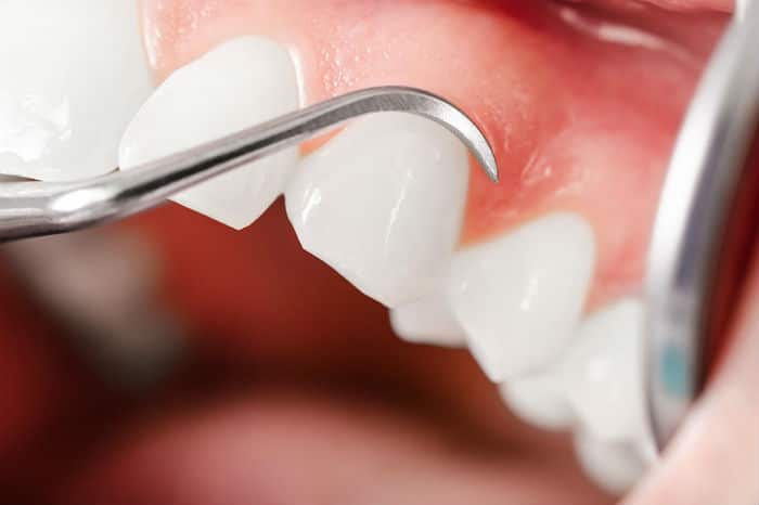 periodoncia-clinica dental barcelona