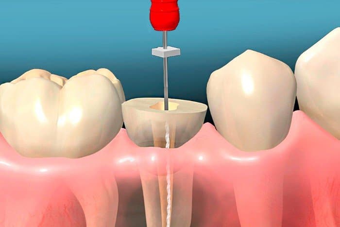 endodoncia-unirradicular barcelona