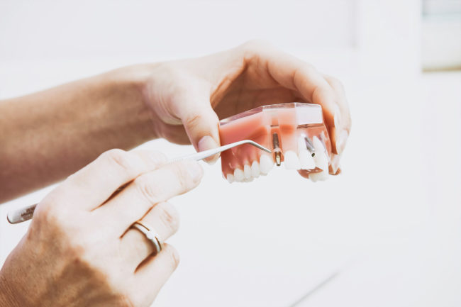 implantes-dentales-barcelona-clinica-puyuelo
