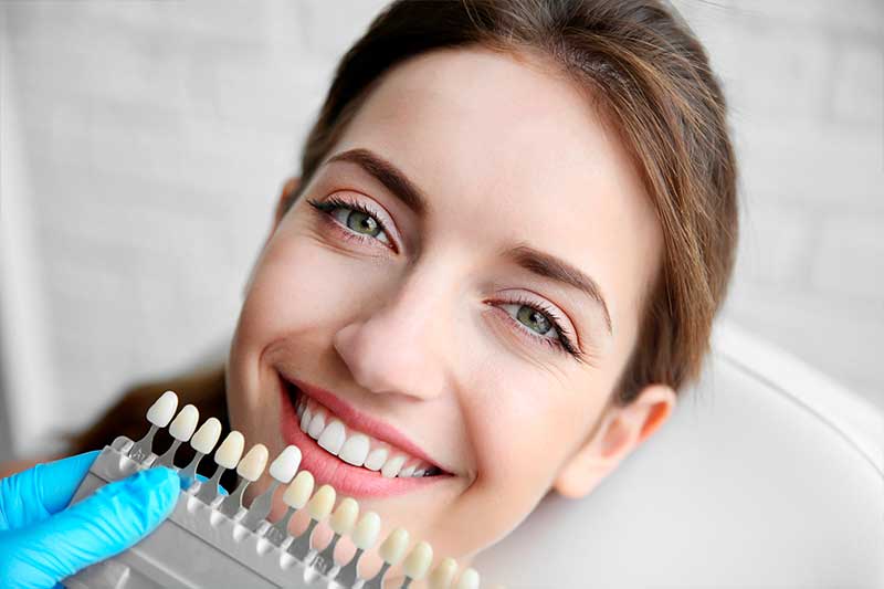 dental-veneers-how-much-does-it-cost-puyuelo