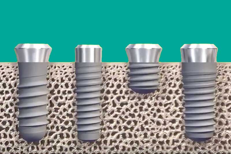 implantes-partes-straumann-roxolid-clinica-dental-puyuelo-barcelona