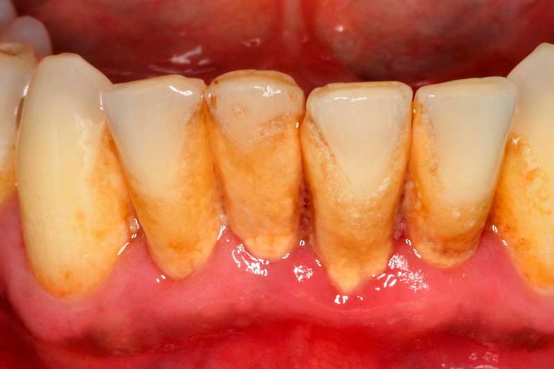 sangrado-encias-clinica-dental-puyuelo-barcelona