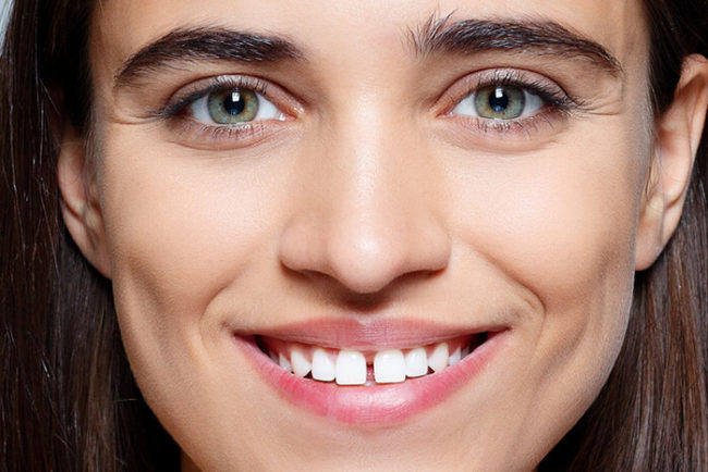 espacio-entre-dientes-diastema-clinica-dental-puyuelo-barcelona espacio-entre-dientes-diastema-clinica-dental-puyuelo-barcelona