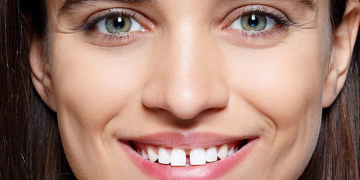 espacio-entre-dientes-diastema-clinica-dental-puyuelo-barcelona espacio-entre-dientes-diastema-clinica-dental-puyuelo-barcelona
