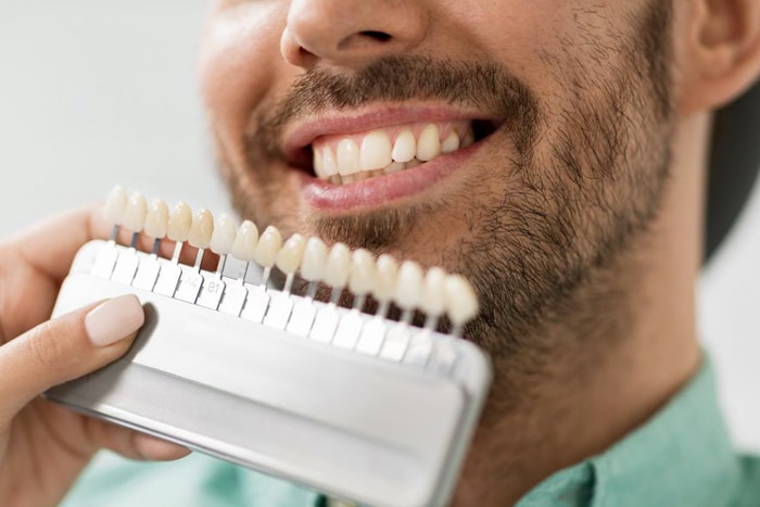 carillas-dentales-estetica-dental-solucion