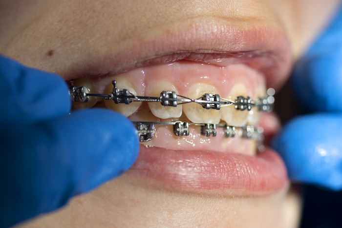 problemas-mordida-clinica-puyuelo-dientes-dentista