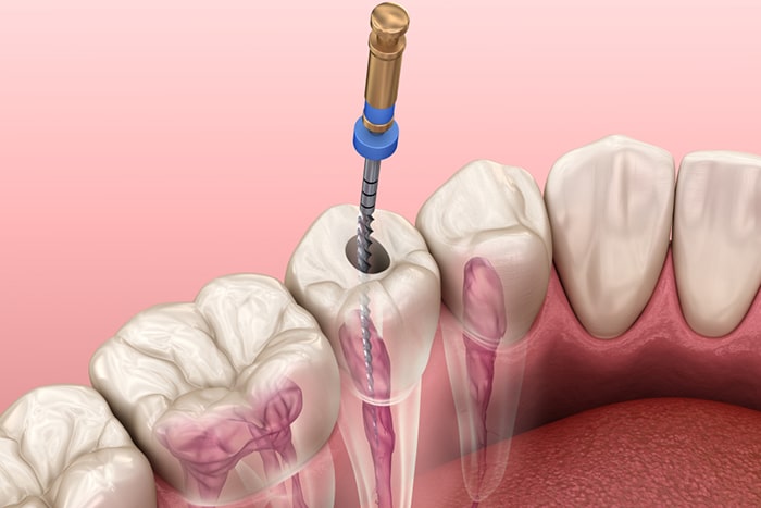 endodoncia-en-barcelona-matar-el-nervio-de-un-diente-2