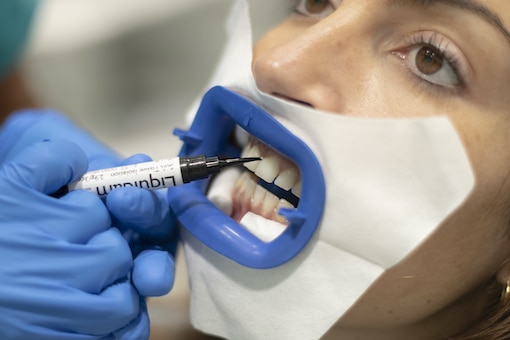 blanqueamiento-dental-profesional