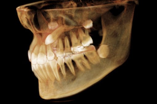cbct-tac-3d