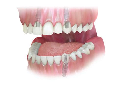 dentadura de clinica dental en barcelona