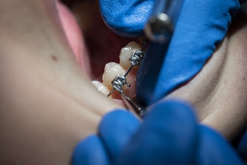 ortodoncia-con-brackets