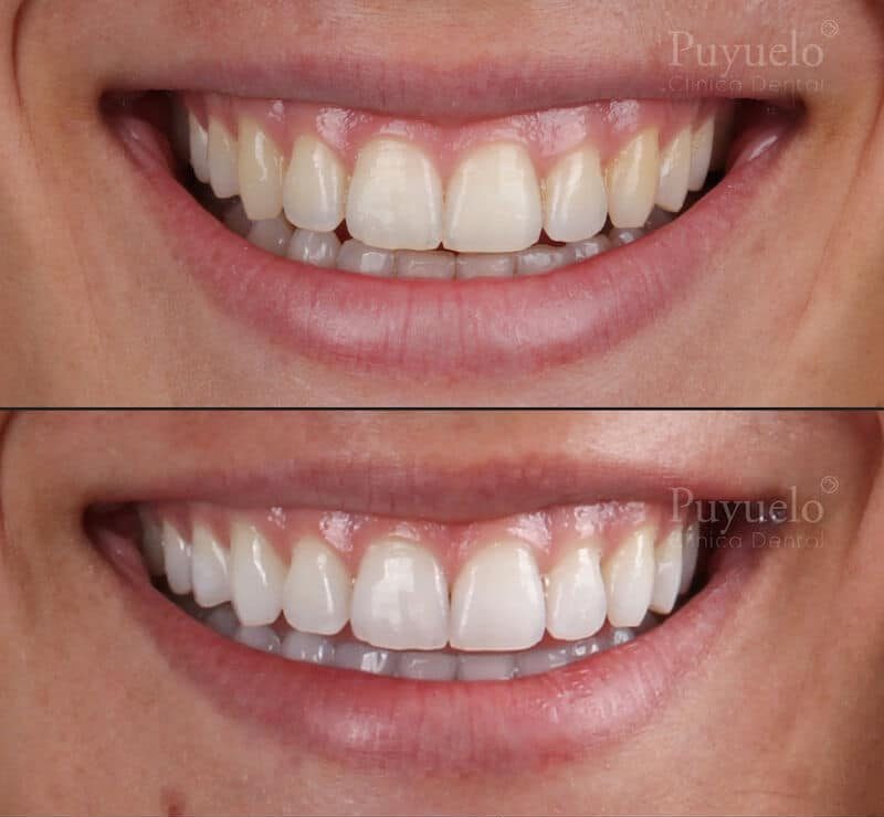 antes y despues de blanqueamiento dental antes y despues de blanqueamiento dental