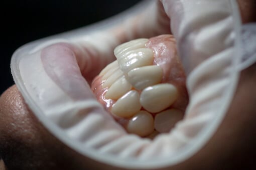 fundas dentales en barcelona