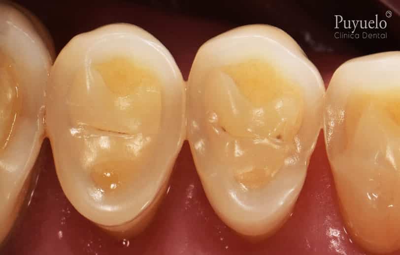 abfraccion dental abfraccion dental