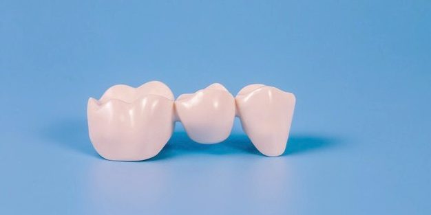 puente dental fijo
