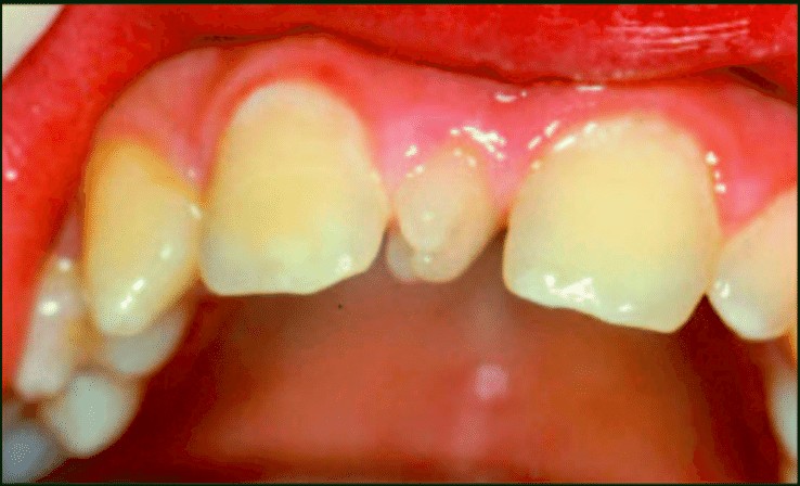 hiperdoncia o dientes supernumerarios