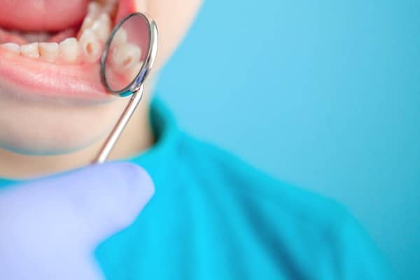 caries interproximales como tratarlas