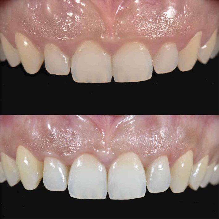Alargamiento de corona para corregir sonrisa gingival