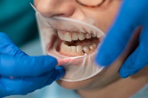 higienista dental funciones