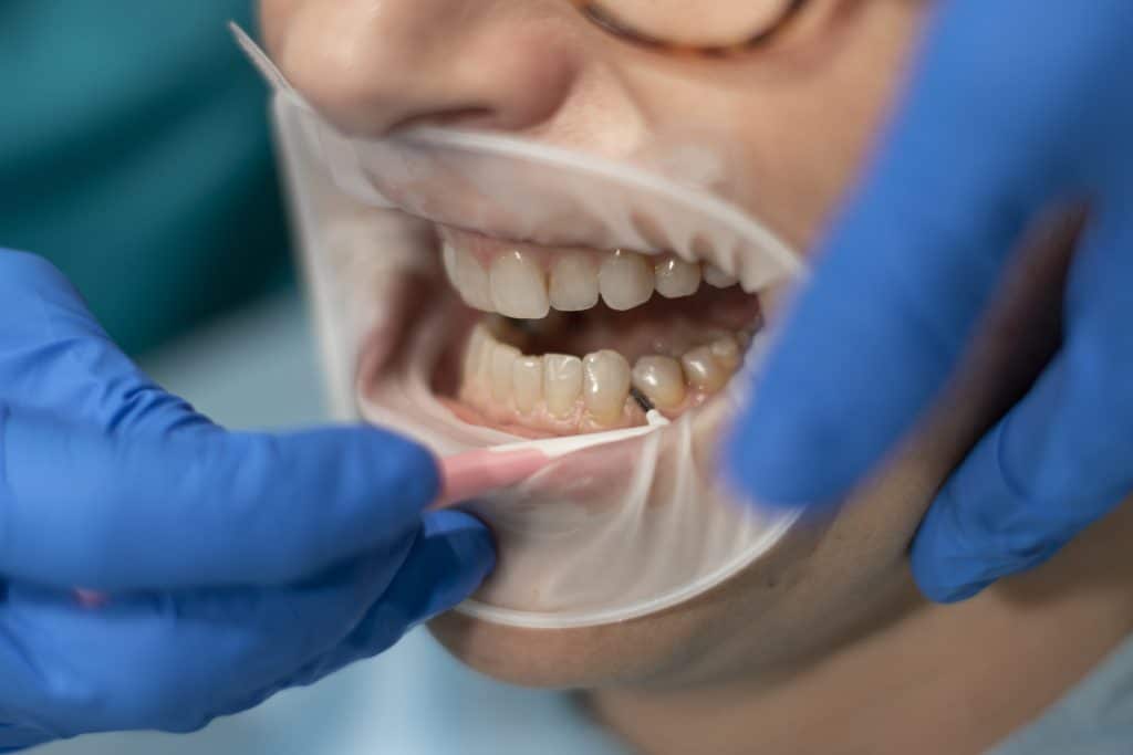 What is dental prophylaxis and when is it performed? - Secondary photo of the blog at Clínica Puyuelo