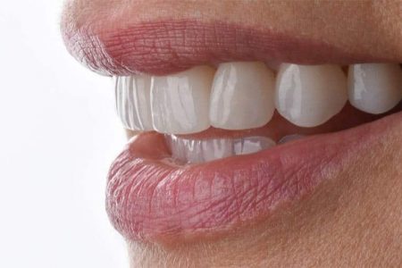 tratamiento carillas dentales