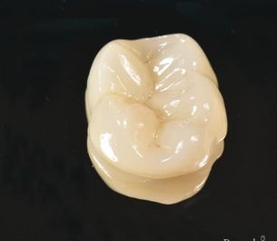 incrustacion dental puyuelo