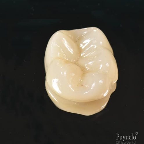 incrustacion dental puyuelo