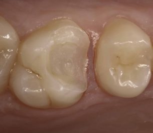 protesis dental incrustacion