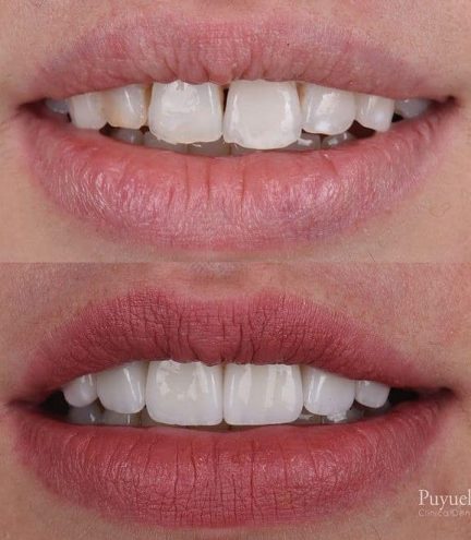 antes y despues desgastes dentales