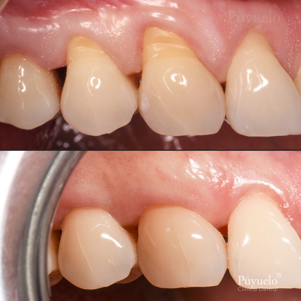 Recessions treated with gingival grafting
