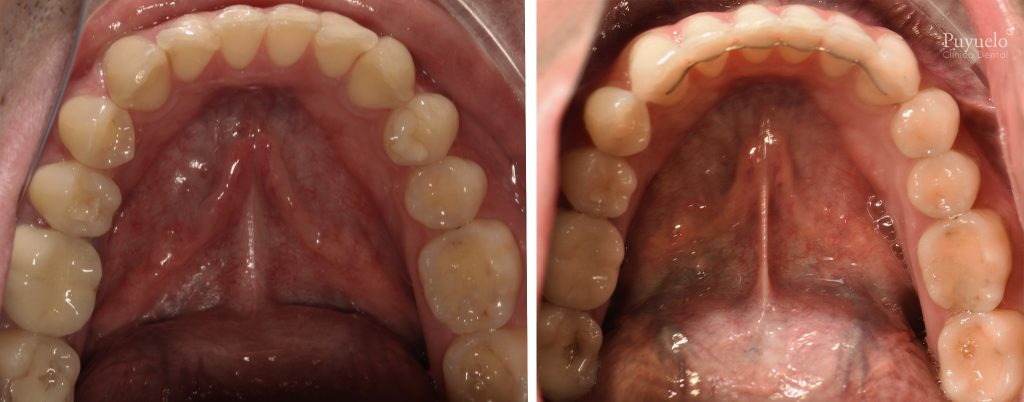 antes y despues retenedores