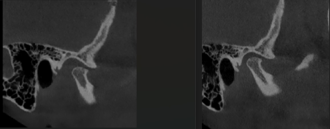 antes crujido mandibular antes crujido mandibular