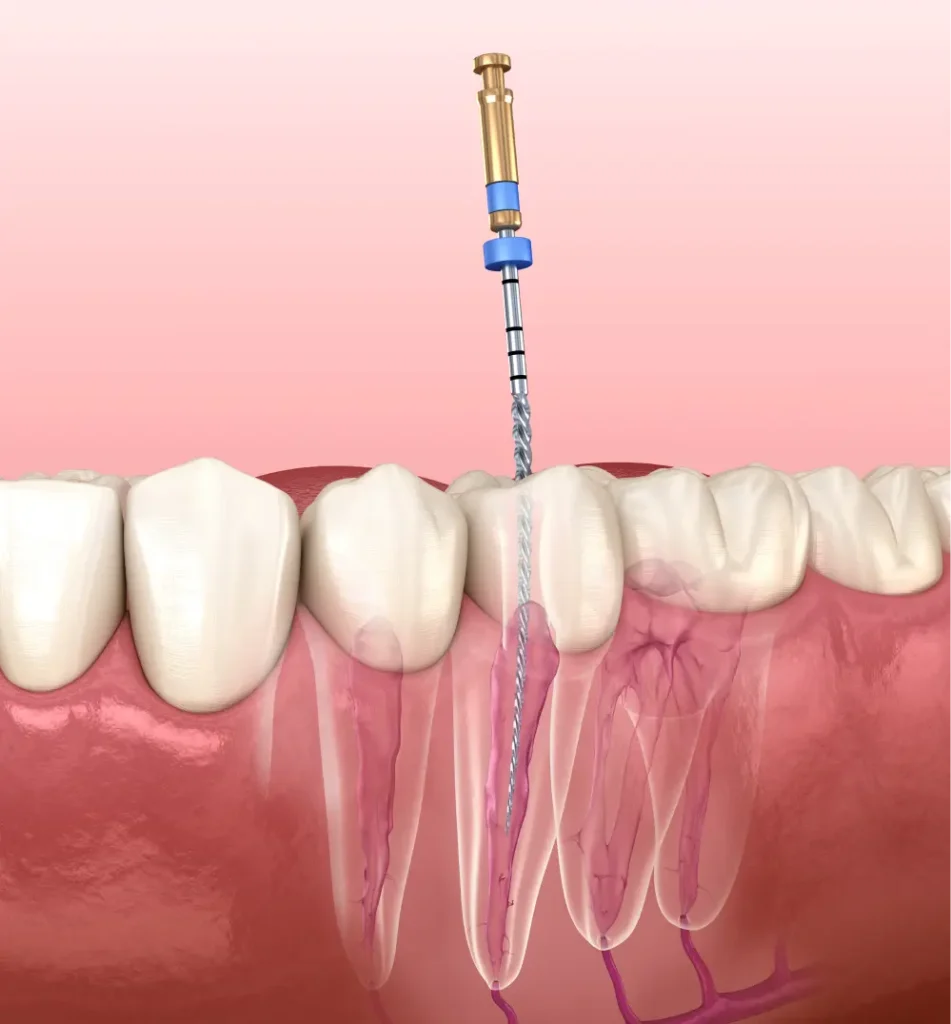 Esquema de endodoncia mostrando la etapa del tratamiento en la raíz dental