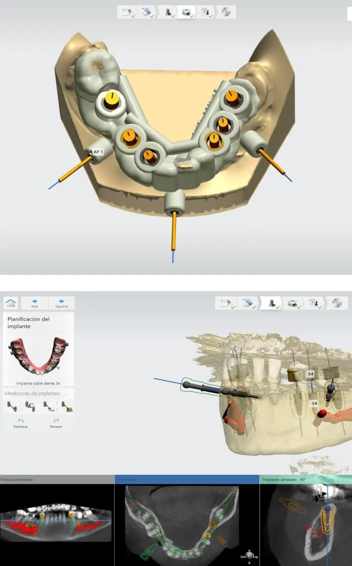radiografía del hueso en 3D
