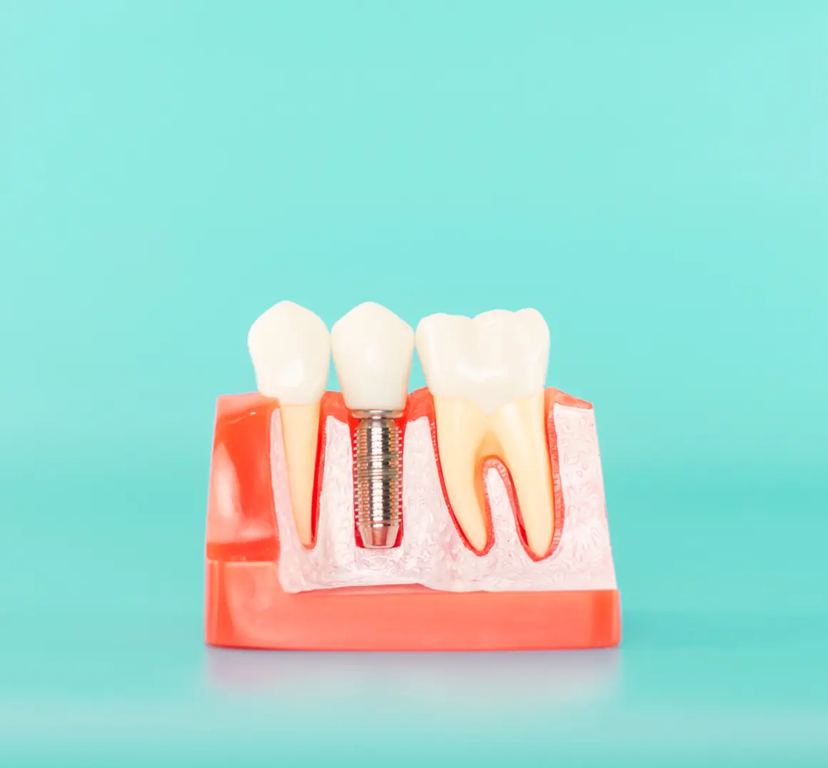 implantes dentales