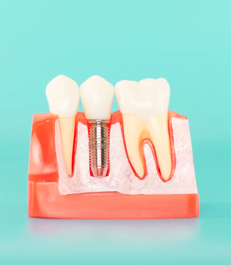 implantes dentales
