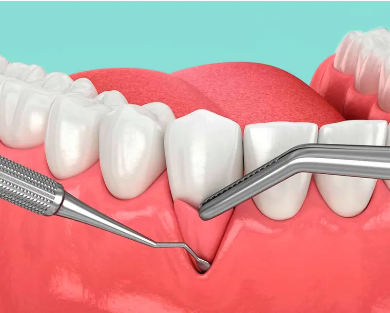 Injertos de encía en zonas de implantes