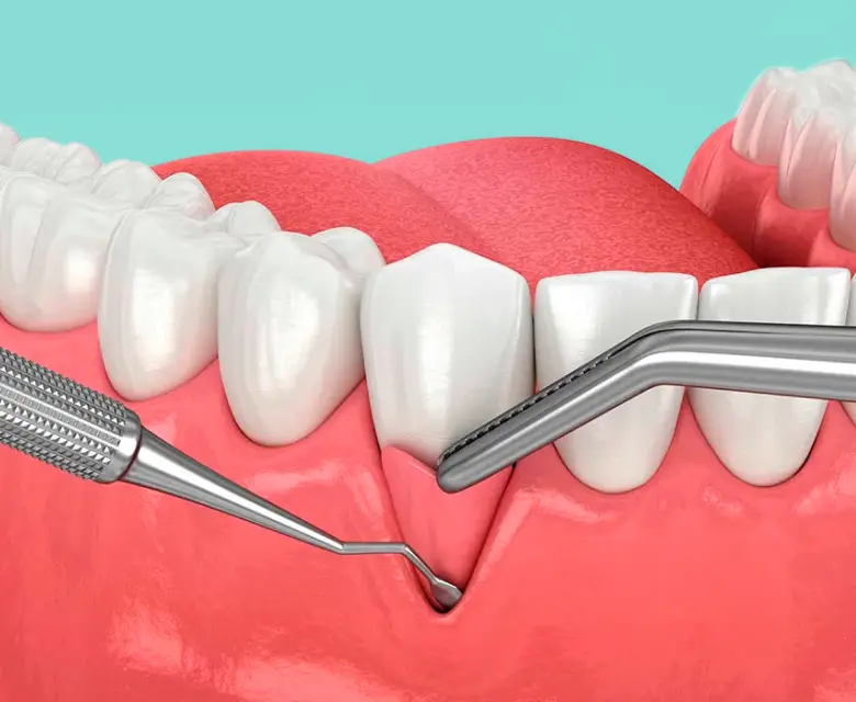 Injertos de encía en zonas de implantes