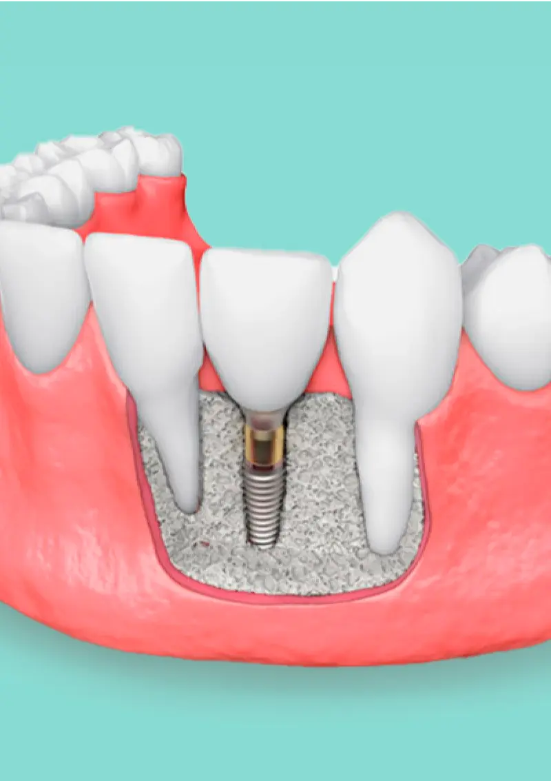 Regeneraciones óseas en zonas de implantes