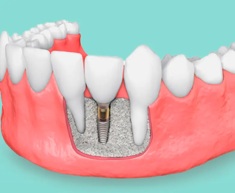 Regeneraciones óseas en zonas de implantes