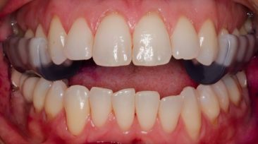 ferula-de-desprogramacion-dental-clinica-puyuelo-barcelona