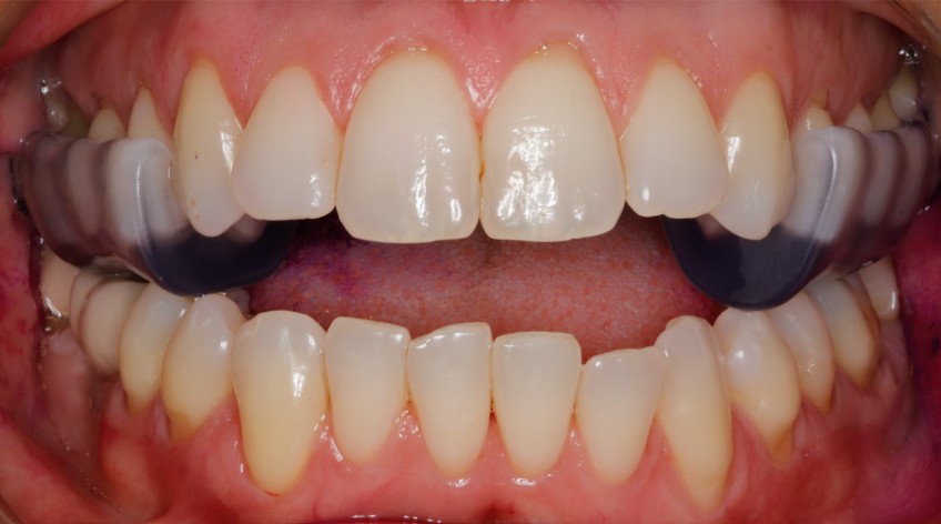 ferula desprogramacion clinica puyuelo